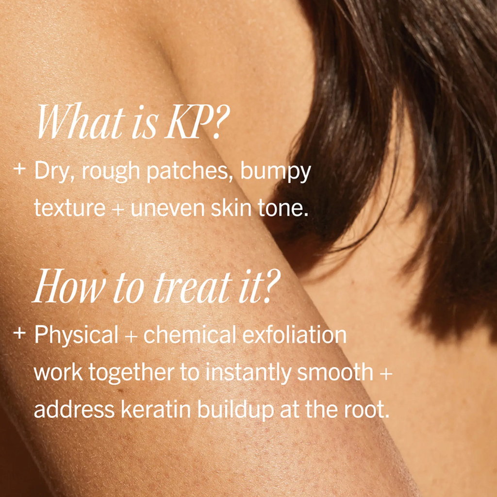 Close-up of a person's shoulder and upper back with overlaid text explaining KP skin concerns and treatment, in warm beige and white lettering.