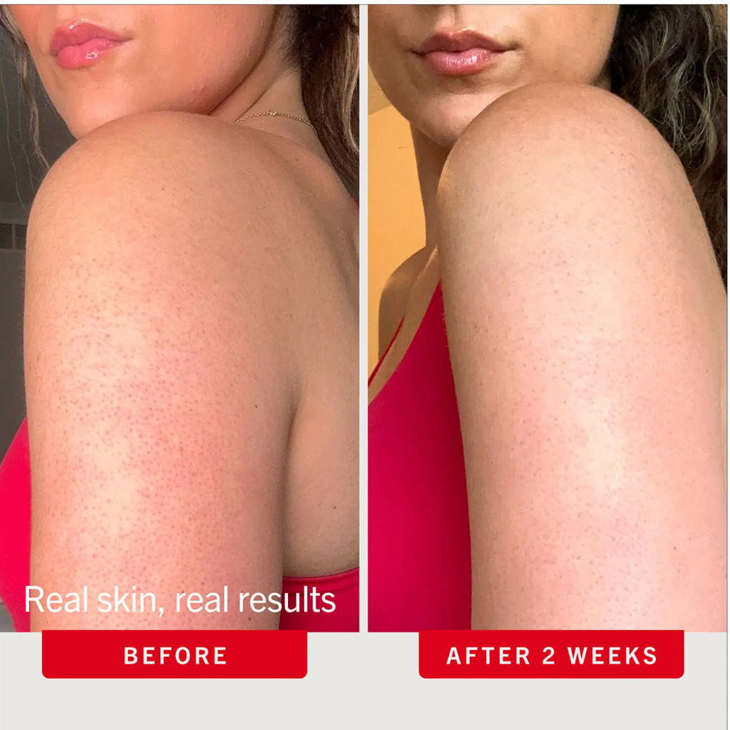 First Aid Beauty KP Bump Eraser Toasted Coconut 10% AHA body scrub benefits