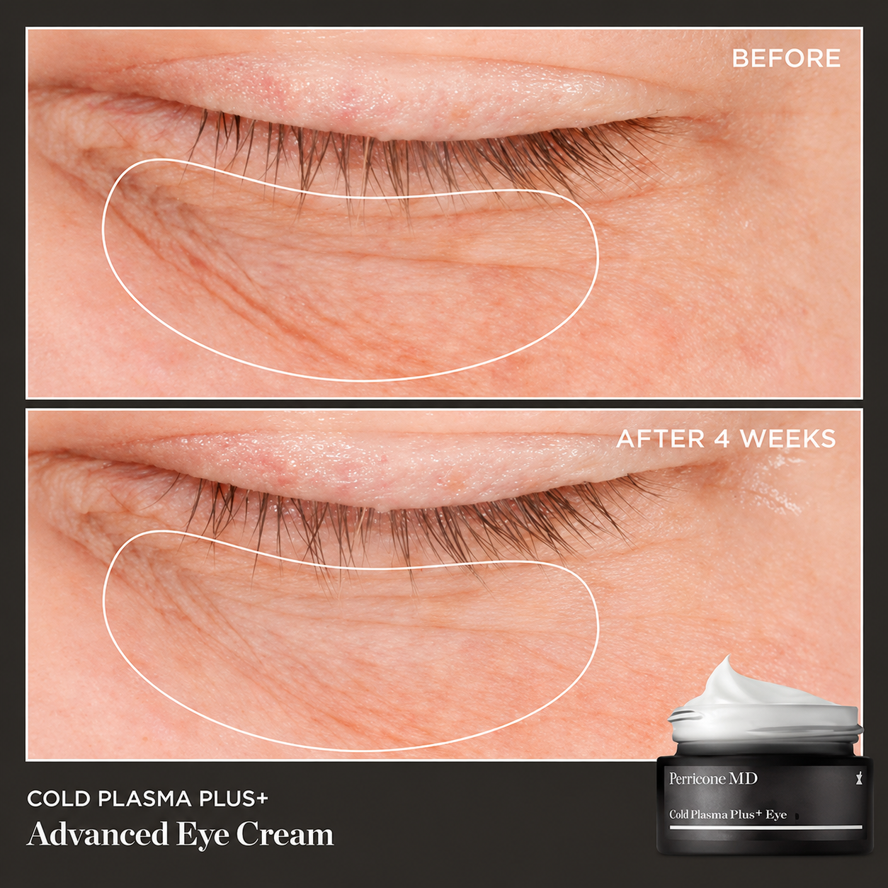 Perricone MD Cold Plasma Plus+ Advanced Eye Cream before-and-after eye-area comparison labeled after 4 weeks