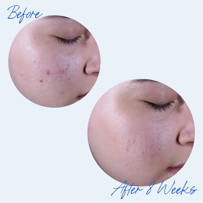 Before and after comparison of a person's cheek showing skin improvement over 8 weeks, with the words 'Before' and 'After 8 Weeks' written in blue script on a light blue background.